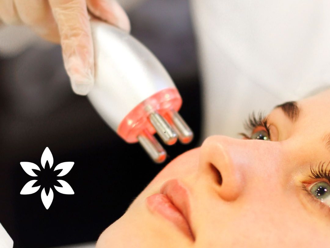 Radiofrecuencia facial