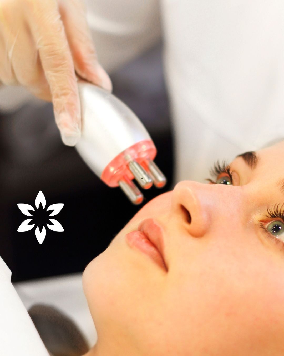 Radiofrecuencia facial